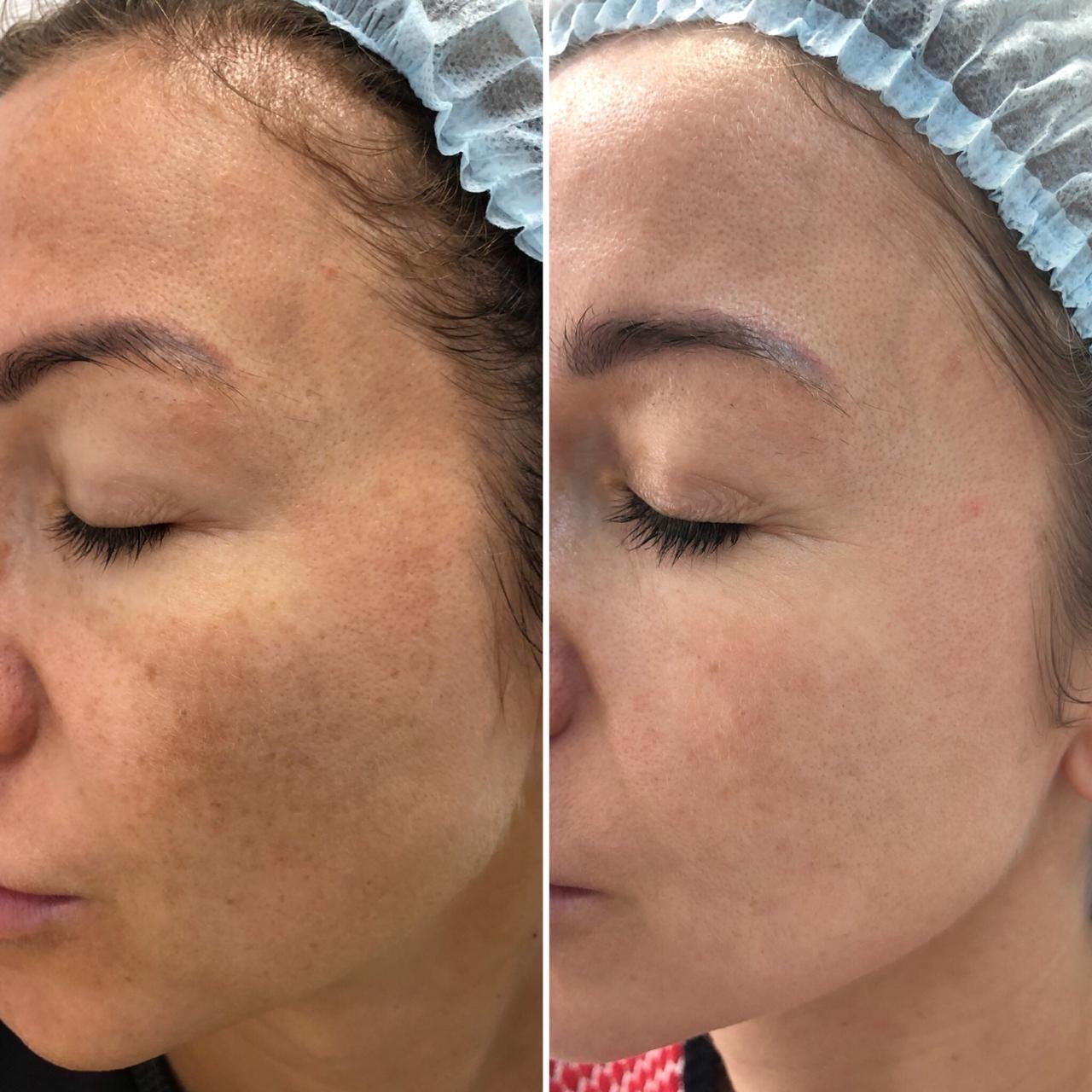 Mencerahkan kulit dengan laser Asclepion area wajah