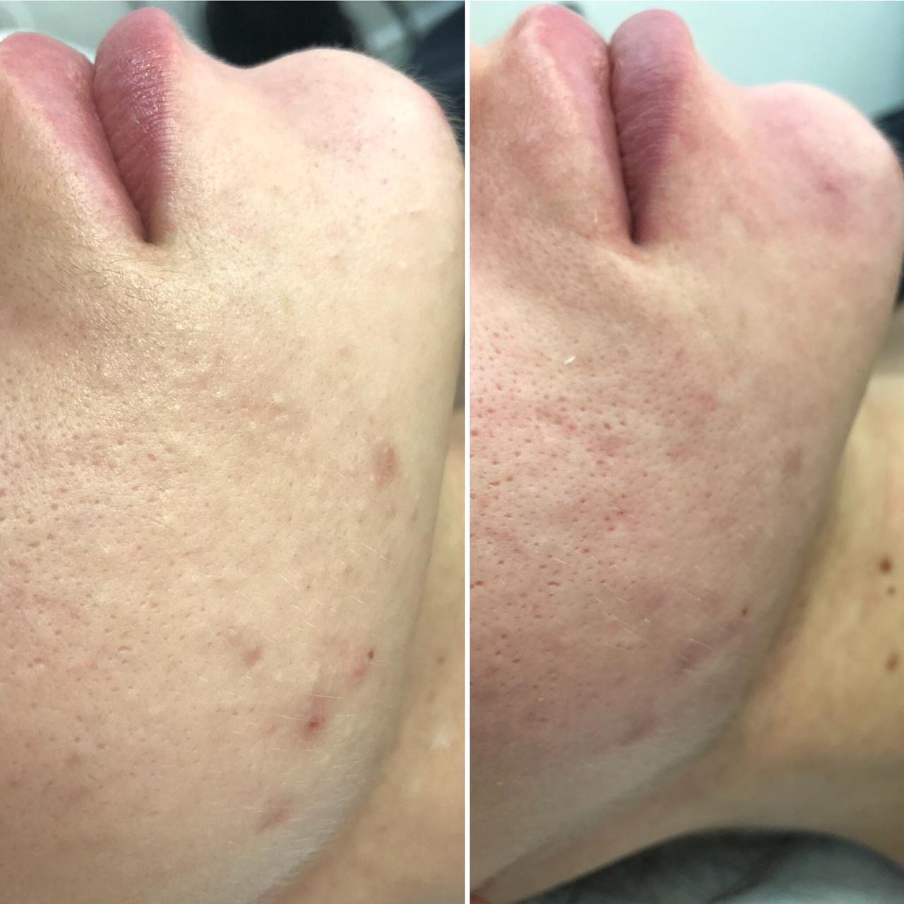 Combined Facial (Include ultrasound + manual)