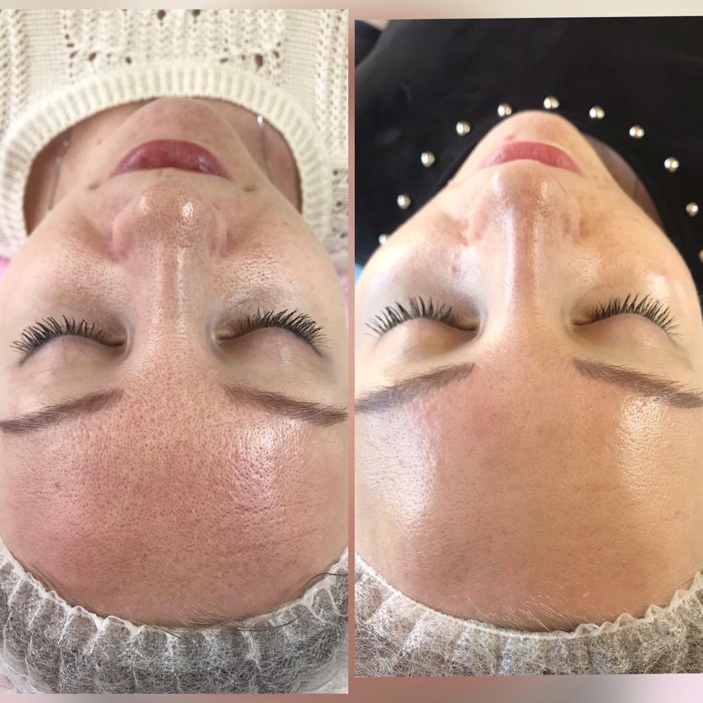 Peremajaan kulit dengan laser Asclepion area wajah