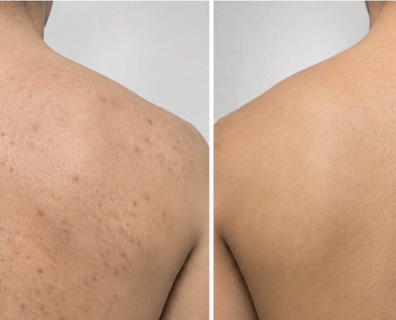 Perawatan jerawat dengan laser Asclepion area bahu