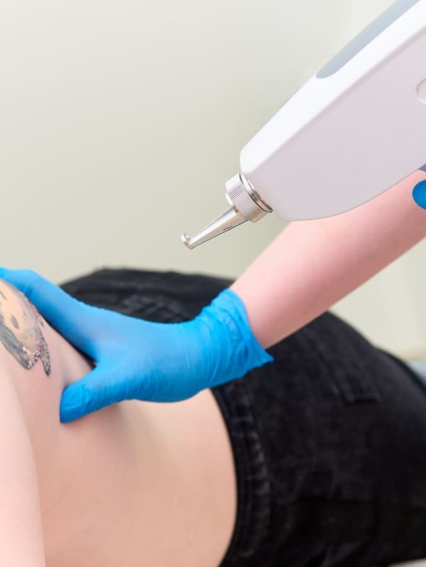 Laser tattoo removal